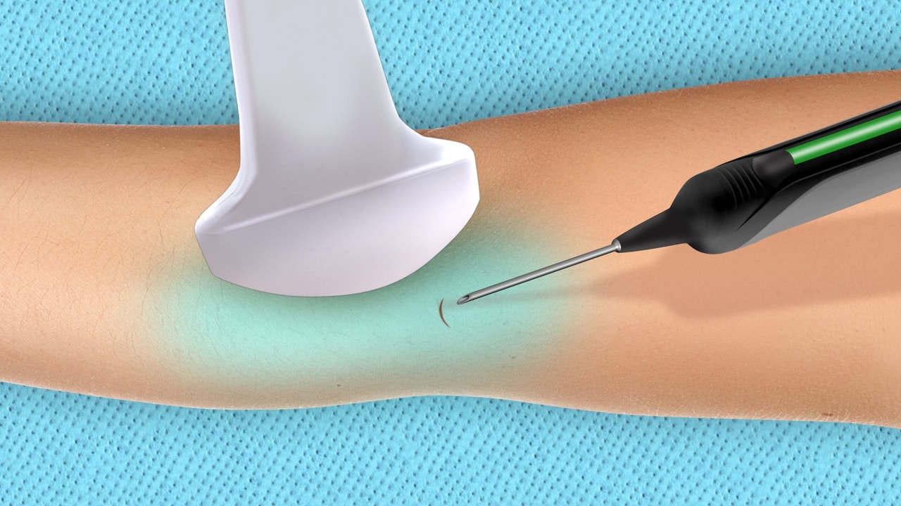 New Tenex Procedure Helps Solve Chronic Tendon Pain The Regenerative