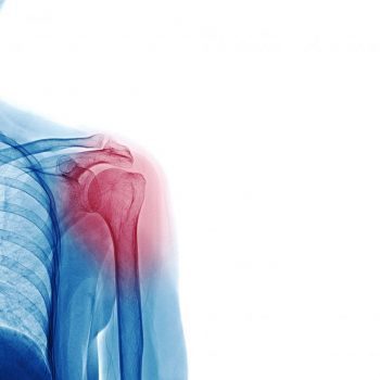 Shoulder arthritis: causes, diagnosis and treatment