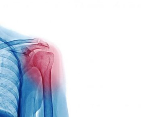 Shoulder arthritis: causes, diagnosis and treatment
