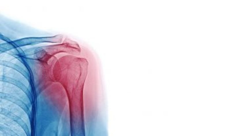 Shoulder arthritis: causes, diagnosis and treatment