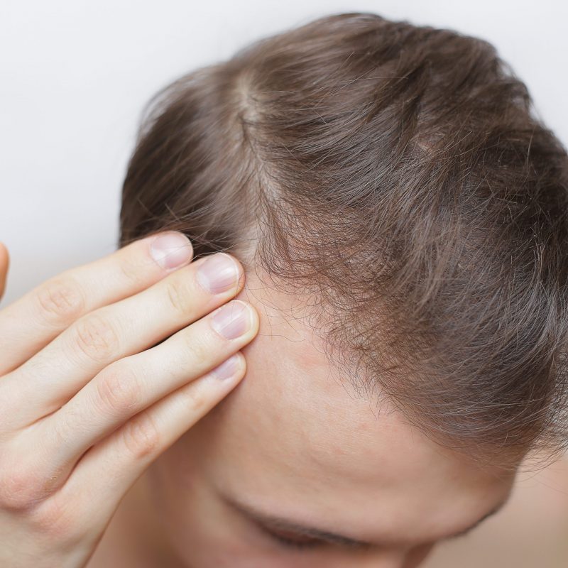 The Psychology of Hair Loss