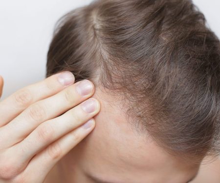The Psychology of Hair Loss
