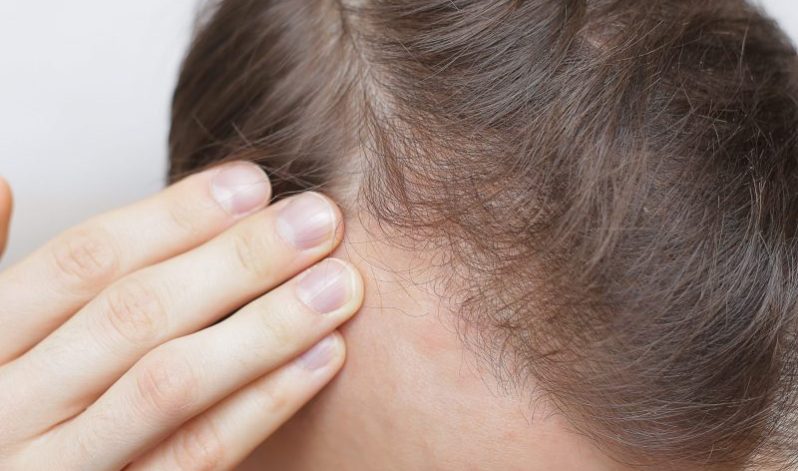 The Psychology of Hair Loss