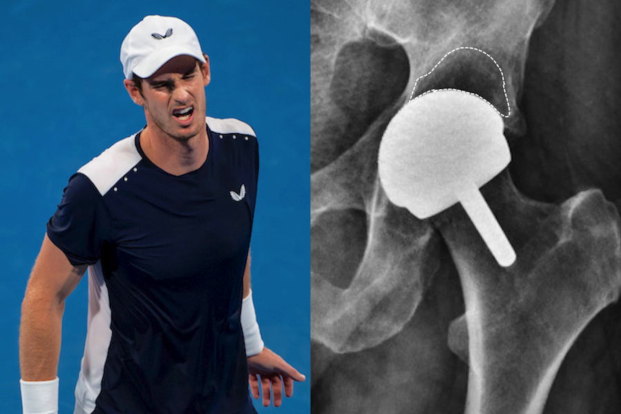 Andy Murray documentary: What we can learn about major orthopaedic surgery from Resurfacing