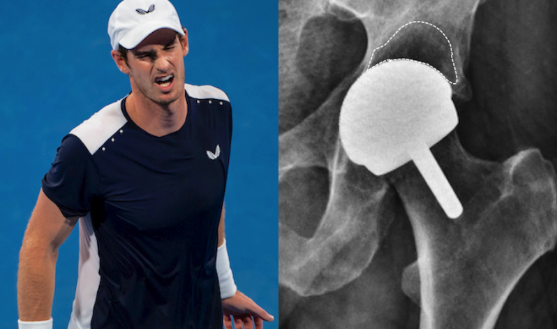 Andy Murray documentary: What we can learn about major orthopaedic surgery from Resurfacing