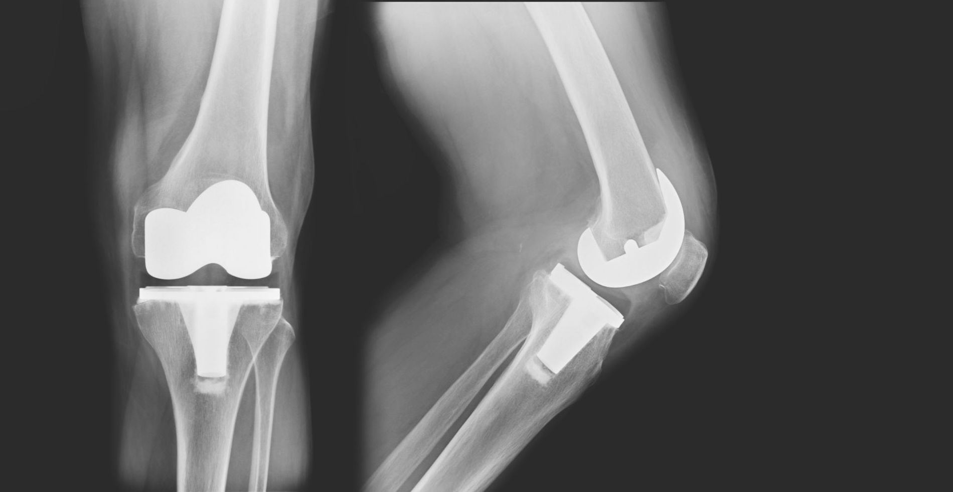 Study Finds 26% Of Knee Replacements Are Premature