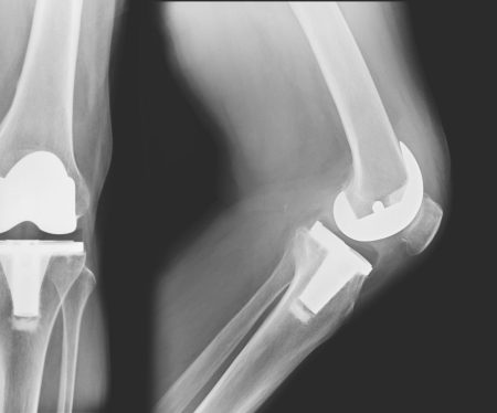 Study Finds 26% Of Knee Replacements Are Premature