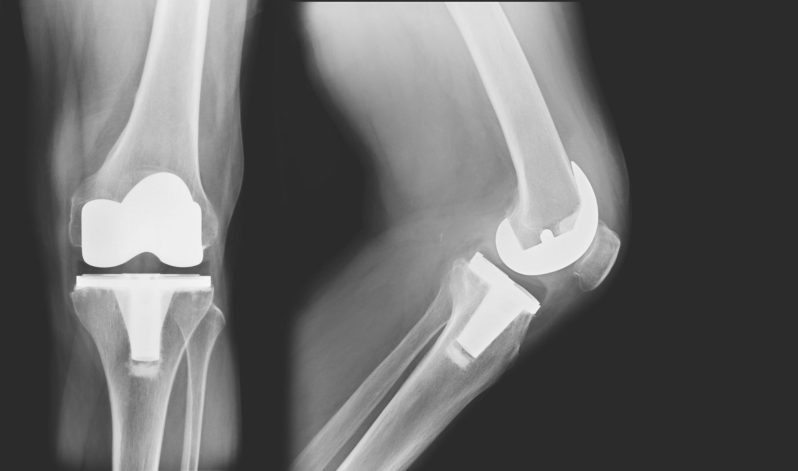 Study Finds 26% Of Knee Replacements Are Premature