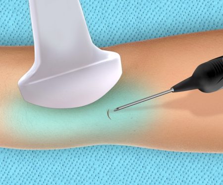 New Tenex Procedure Helps Solve Chronic Tendon Pain