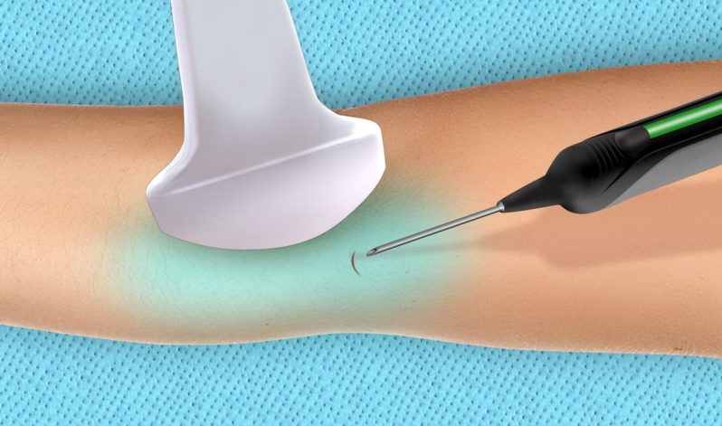 New Tenex Procedure Helps Solve Chronic Tendon Pain